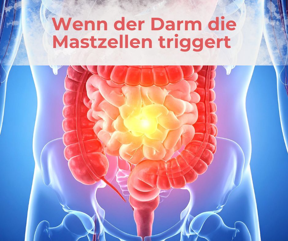 Wenn der Darm die Mastzellen triggert – SIBO, IMO und Fehlbesiedlungen als Auslöser